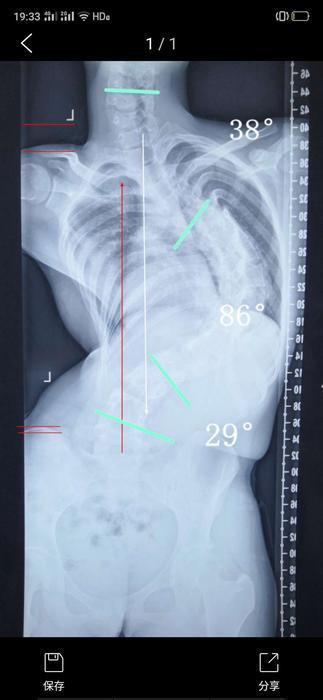 3D打印技术助脊柱侧弯女孩“长高”12厘米