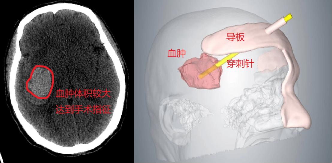 3D打印导板导航下的脑出血治疗新篇章