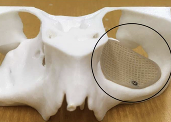 巴塞尔大学：独特的多孔3D打印植入物设计用于治疗眼窝骨折