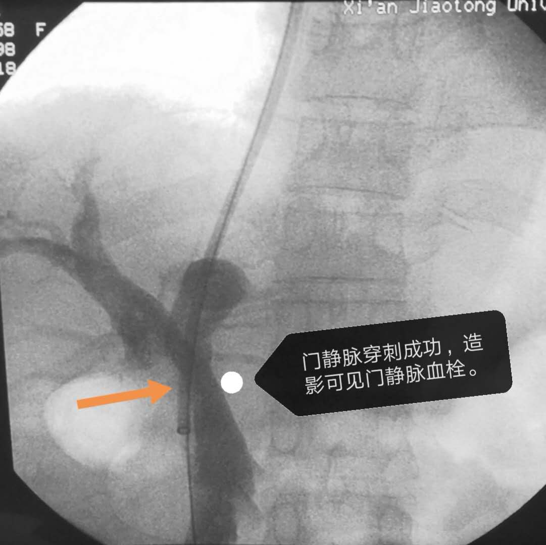 消化内科完成国内首例个体化3D打印精准辅助TIPS穿刺手术