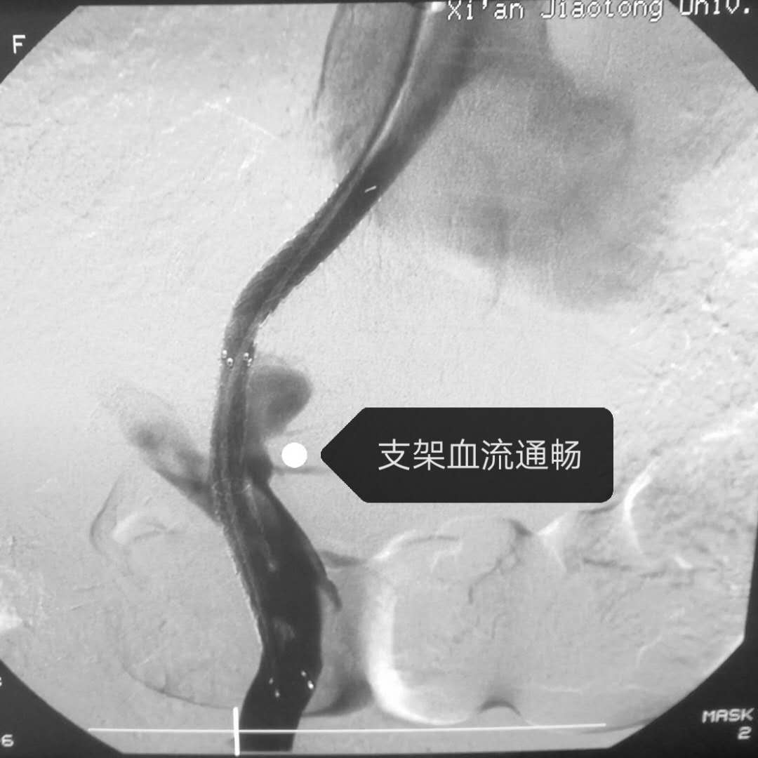 消化内科完成国内首例个体化3D打印精准辅助TIPS穿刺手术